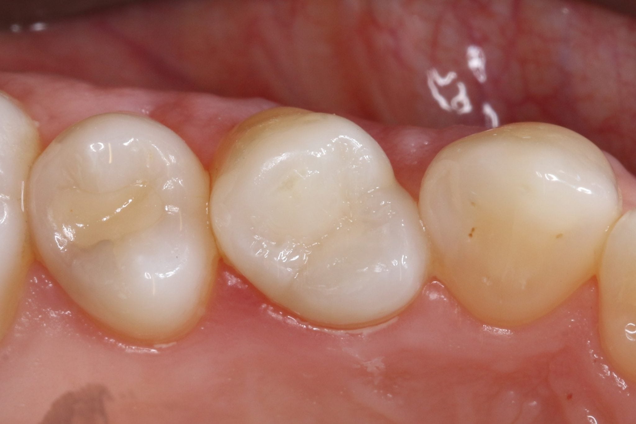 white dental fillings kelowna