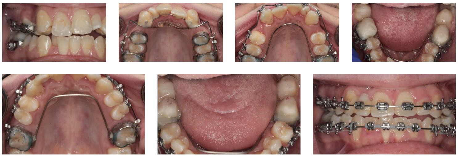 dental braces kelowna 1