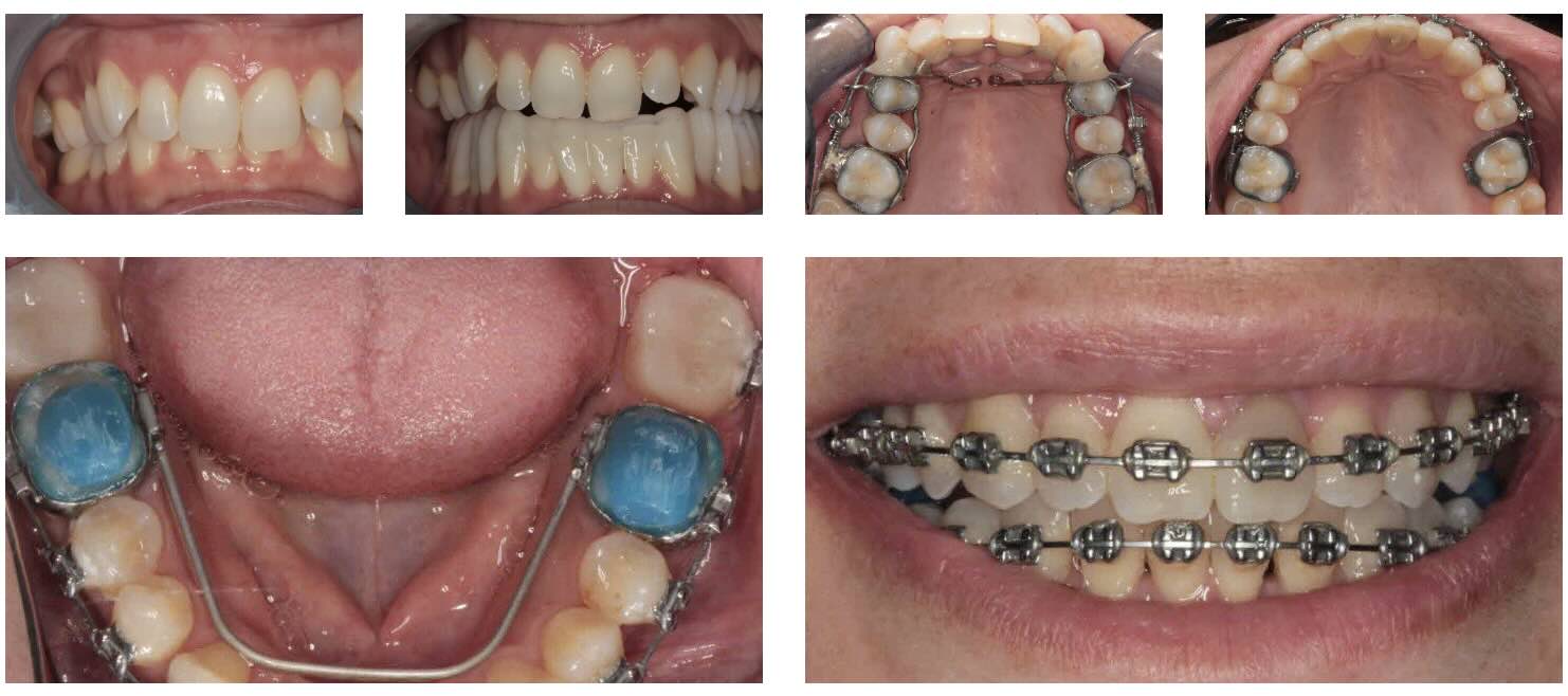 dental braces kelowna 2