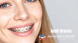 adult-braces-kelowna