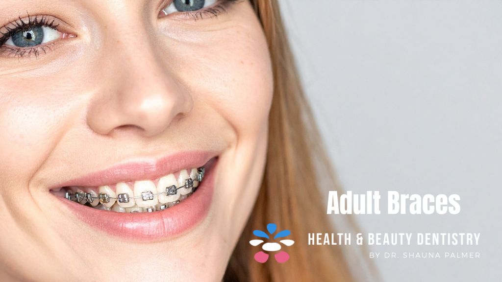 adult-braces-kelowna