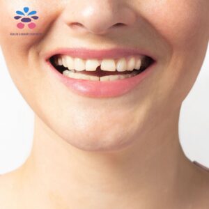 broken-tooth-dentistry-dentist-palmer-kelowna-bc