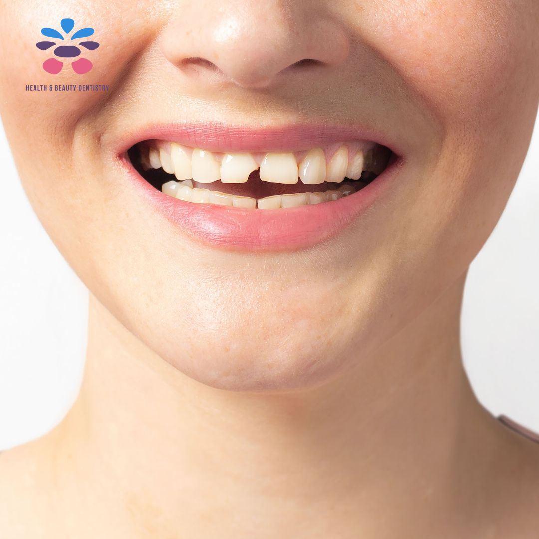 broken-tooth-dentistry-dentist-palmer-kelowna-bc